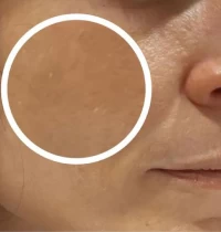 laser-thulium-apres
