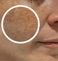 laser-thulium-avant